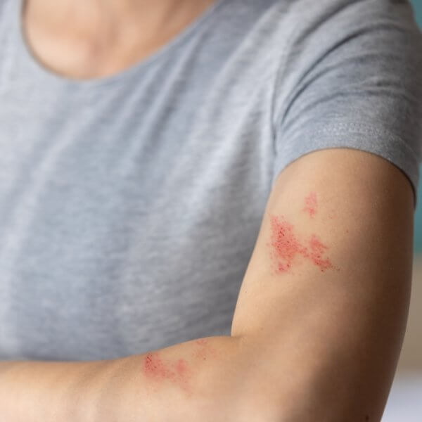 Did you know that the same virus causes shingles as chickenpox?