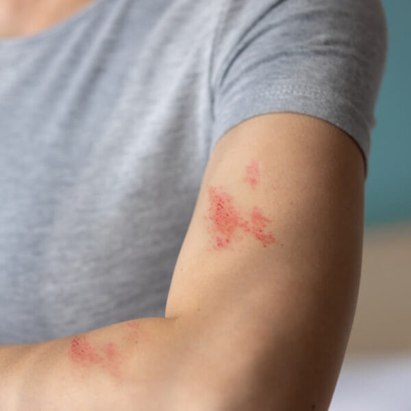 Shingles: Symptoms, Causes, and Treatments