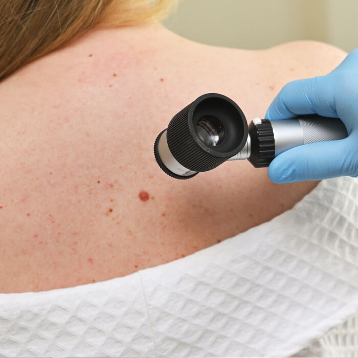 Cáncer en la piel: señales, prevención y cuándo visitar al especialista